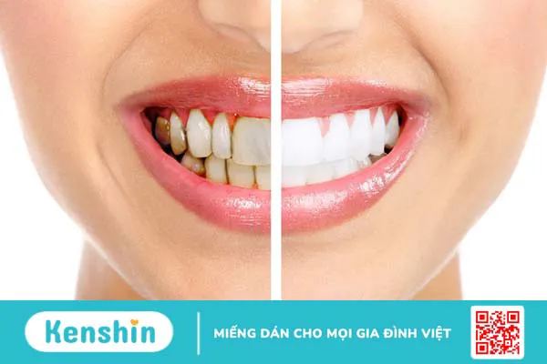 Các loại răng sứ thẩm mỹ phổ biến hiện nay