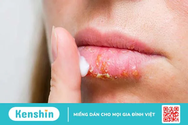 Các nguyên nhân phổ biến gây viêm môi cơ địa và cách phòng tránh