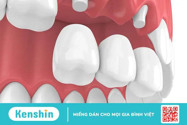 Các phương pháp trồng răng hiệu quả nhất hiện nay