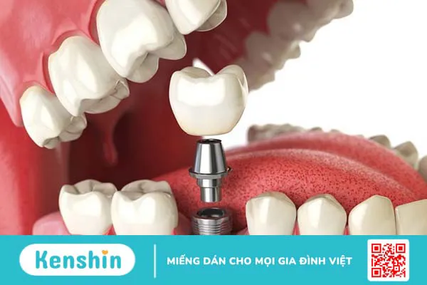 Các phương pháp trồng răng hiệu quả nhất hiện nay 2