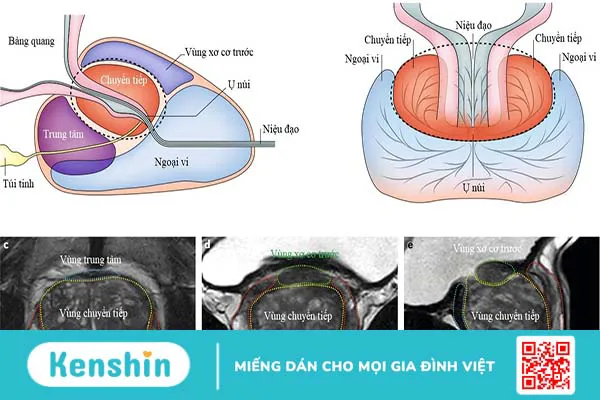 Các trường hợp cần sinh thiết tuyến tiền liệt qua hướng dẫn của siêu âm kết hợp MRI