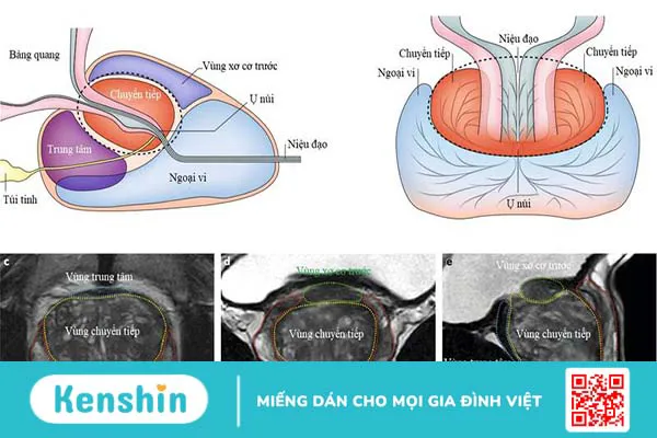 Các trường hợp cần sinh thiết tuyến tiền liệt qua hướng dẫn của siêu âm kết hợp MRI