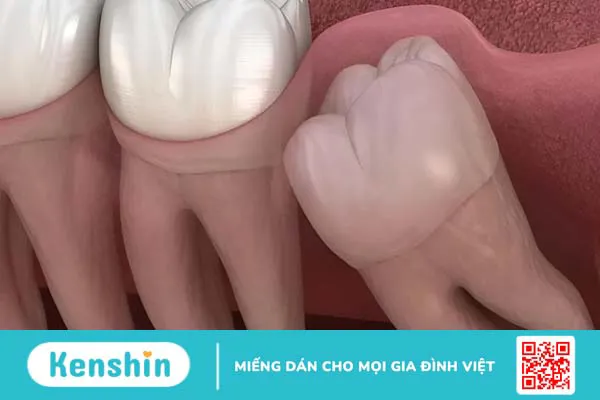 Cách chăm sóc sau nhổ răng khôn và những điều cần lưu ý