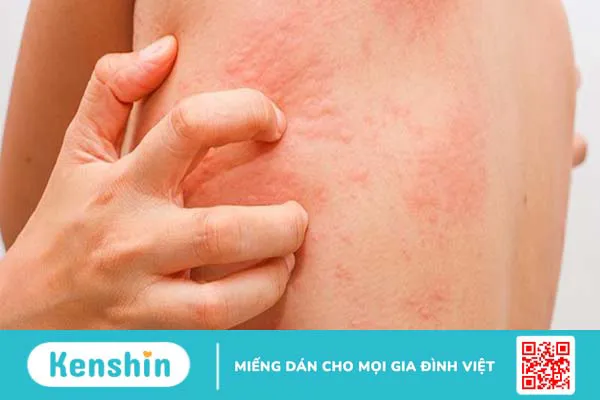 Cách chữa dị ứng khi ăn côn trùng tại nhà 4