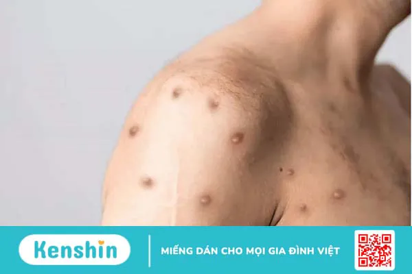 Cách chữa thủy đậu ở người lớn nhanh nhất và an toàn