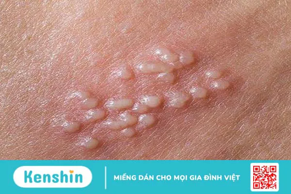 Cách đào thải virus HPV ra khỏi cơ thể triệt để