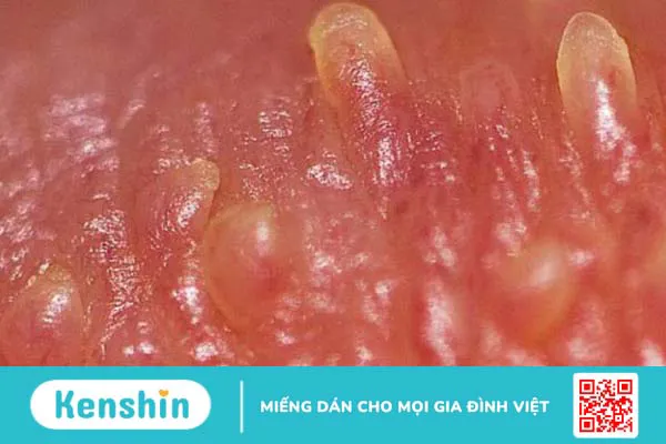 Cách đào thải virus HPV ra khỏi cơ thể triệt để