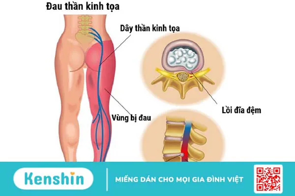 Cách điều trị đau thần kinh tọa do thoát vị đĩa đệm là gì? 1