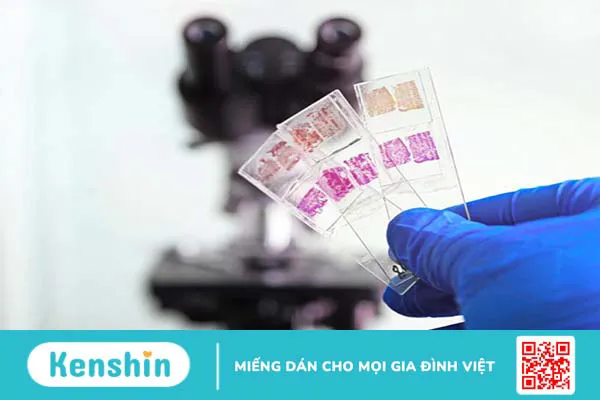 Cách đọc kết quả hóa mô miễn dịch như thế nào?