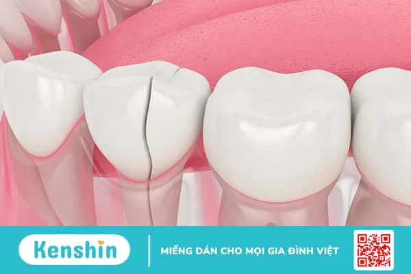 Cách giảm đau răng sau khi lấy tủy hiệu quả mà bạn có thể tham khảo