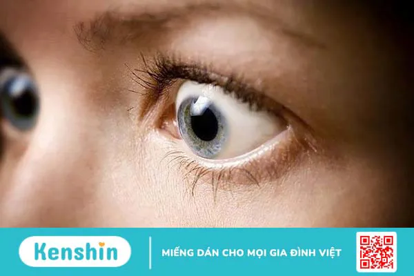 Cách giảm lồi mắt hiệu quả ai cũng nên biết