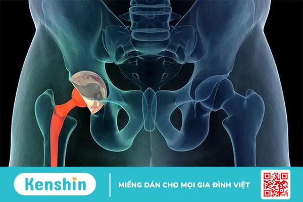 Cách làm giảm đau cơ háng nhanh chóng tại nhà ai cũng nên biết 1