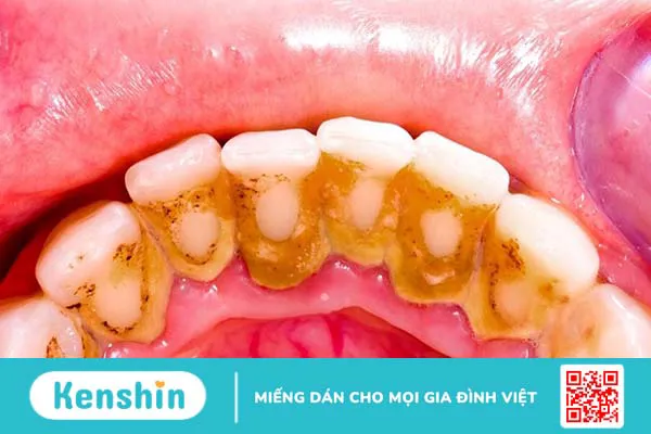 Cách phân biệt cao răng và mảng bám chuẩn xác