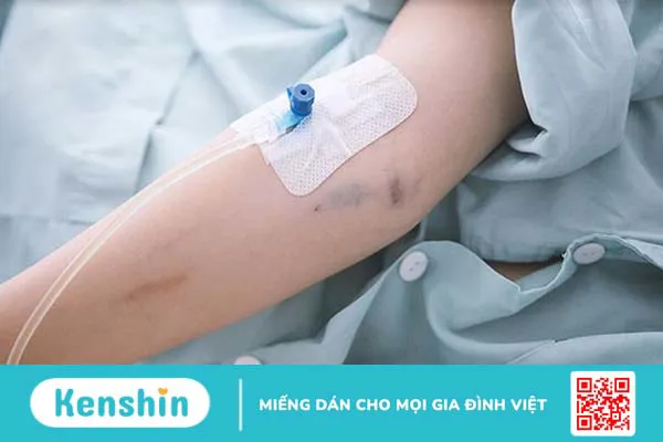 Cách test sốt xuất huyết tại nhà