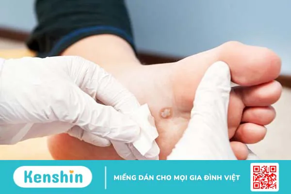 Cách trị mắt cá dưới lòng bàn chân tránh nguy cơ nhiễm trùng