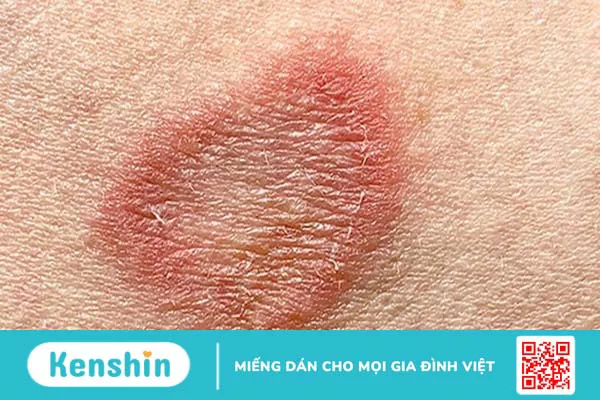 Cách trị tận gốc bệnh nấm vùng kín hiệu quả và an toàn