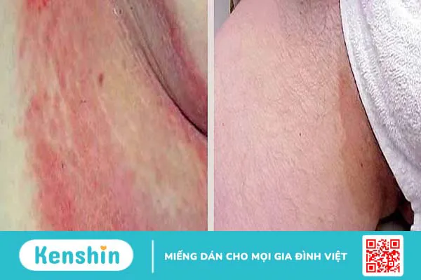 Cách trị tận gốc bệnh nấm vùng kín hiệu quả và an toàn