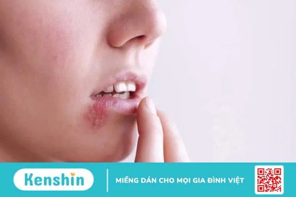 Cách trị viêm môi dị ứng tại nhà có hiệu quả không?