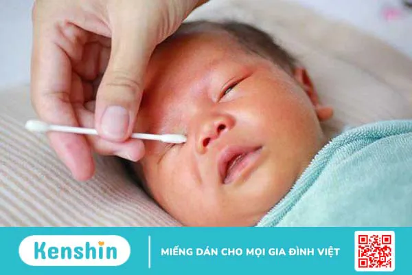 Cách xử lý lông mi quặm ở trẻ sơ sinh chính xác và an toàn 1