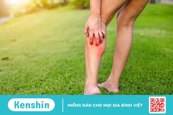 Cách xử lý vết côn trùng cắn sưng đỏ ngứa tại nhà