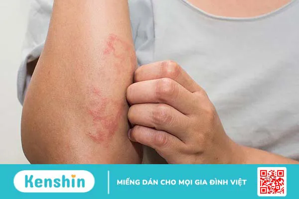 Cách xử lý vết côn trùng cắn sưng đỏ ngứa tại nhà