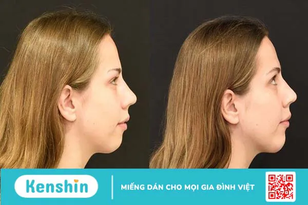 Cằm lẹm: Nguyên nhân, dấu hiệu nhận biết và cách khắc phục