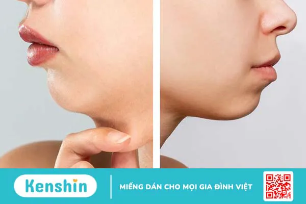 Cằm lẹm: Nguyên nhân, dấu hiệu nhận biết và cách khắc phục