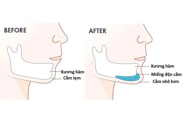 Cằm lẹm: Nguyên nhân, dấu hiệu nhận biết và cách khắc phục