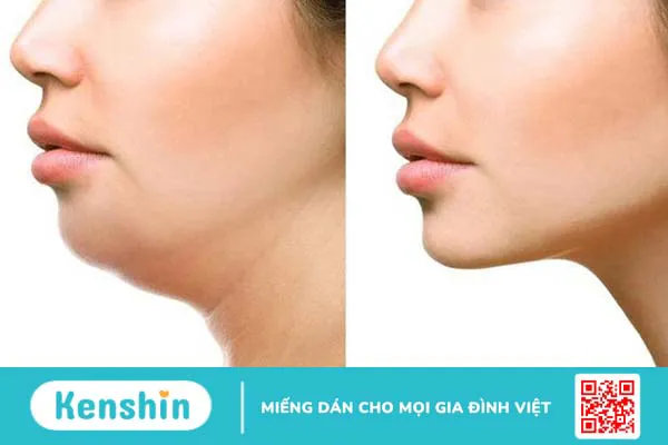 Cằm lẹm: Nguyên nhân, dấu hiệu nhận biết và cách khắc phục