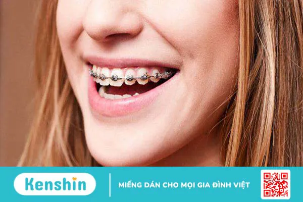 Cắm vít niềng răng bao lâu thì tháo? Niềng răng cần lưu ý những gì?