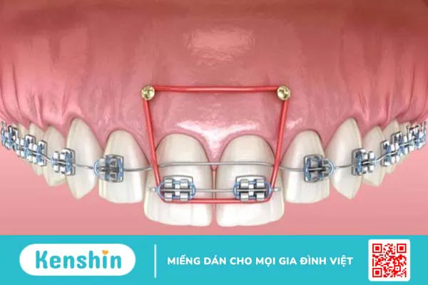 Cắm vít niềng răng bao lâu thì tháo? Niềng răng cần lưu ý những gì?