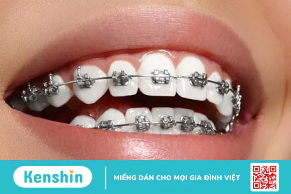 Cắm vít niềng răng bao lâu thì tháo? Niềng răng cần lưu ý những gì?