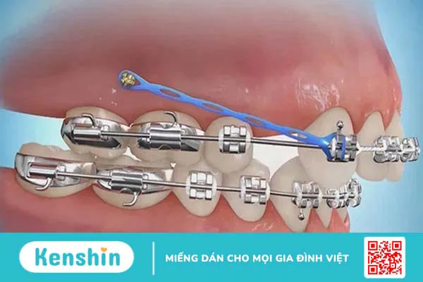 Cắm vít niềng răng bao lâu thì tháo? Niềng răng cần lưu ý những gì?