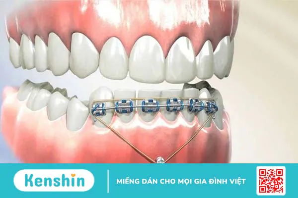 Cắm vít niềng răng có đau không? Những điều bạn cần biết khi niềng răng