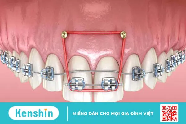 Cắm vít niềng răng có đau không? Những điều bạn cần biết khi niềng răng