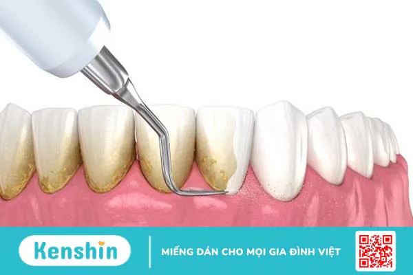 Cao răng tự vỡ liệu có nguy hiểm hay không?