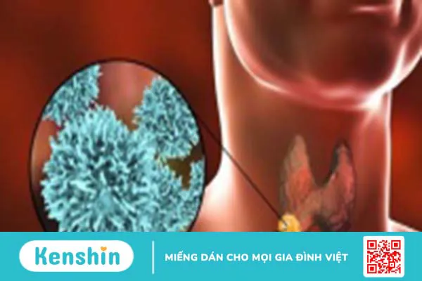 Carcinom là gì? Những điều cần làm khi mắc tuyến giáp dạng nhú