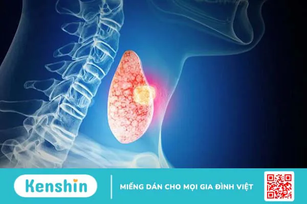 Carcinom là gì? Những điều cần lưu ý khi mắc tuyến giáp dạng nhú 1