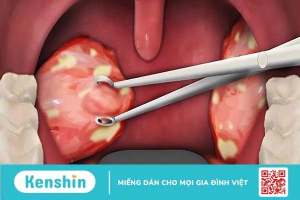 Cắt amidan có ảnh hưởng gì không? Bao lâu thì lành lại?