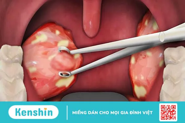 Cắt amidan có ảnh hưởng gì không? Bao lâu thì lành lại?