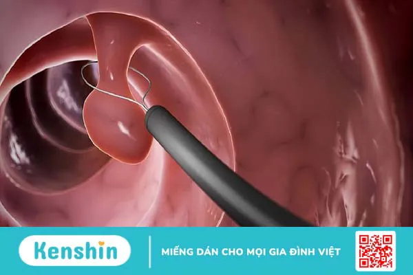 Cắt polyp trực tràng có nguy hiểm không?