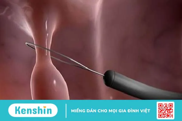 Cắt polyp tử cung bao lâu thì quan hệ lại được? Những lưu ý khi cắt cắt polyp tử cung