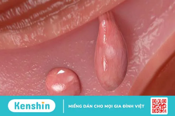 Cắt polyp tử cung bao lâu thì quan hệ lại được? Những lưu ý khi cắt cắt polyp tử cung