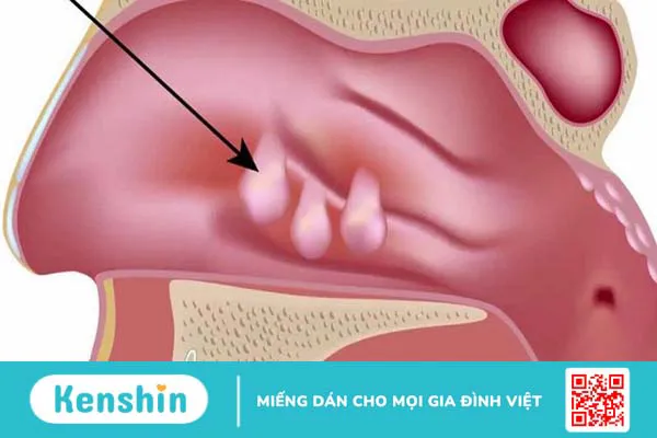 Cắt polyp tử cung bao lâu thì quan hệ lại được? Những lưu ý khi cắt cắt polyp tử cung