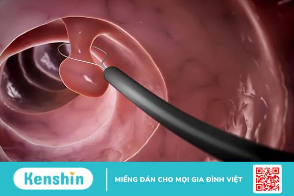 Cắt polyp tử cung bao lâu thì quan hệ lại được? Những lưu ý khi cắt cắt polyp tử cung