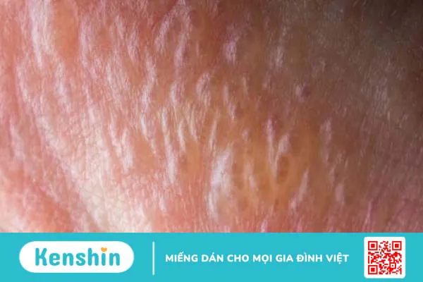 Cậu nhỏ nổi mụn trắng không ngứa là hiện tượng gì?