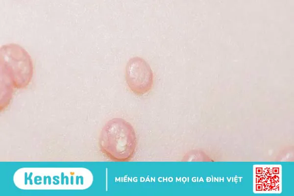 Cậu nhỏ nổi mụn trắng không ngứa là hiện tượng gì? 1