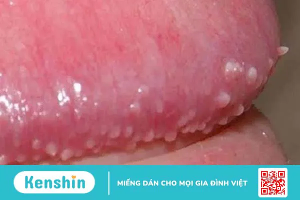 Cậu nhỏ nổi mụn trắng không ngứa là hiện tượng gì? 2