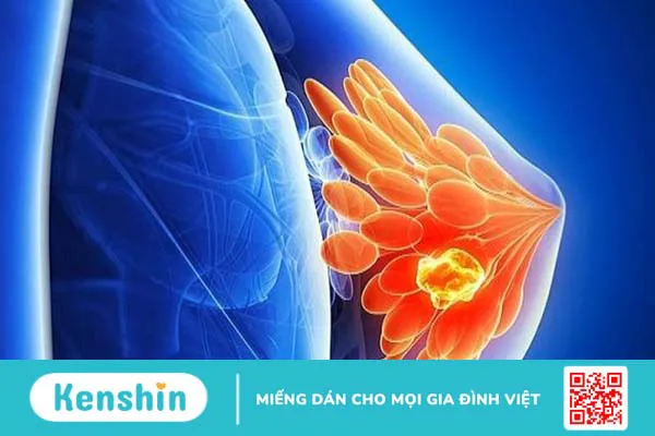 Cấu tạo, chức năng của tuyến vú và các bệnh lý thường gặp