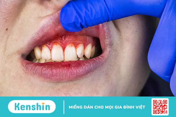 Cấu tạo của nướu răng và các bệnh lý thường gặp ở nướu răng